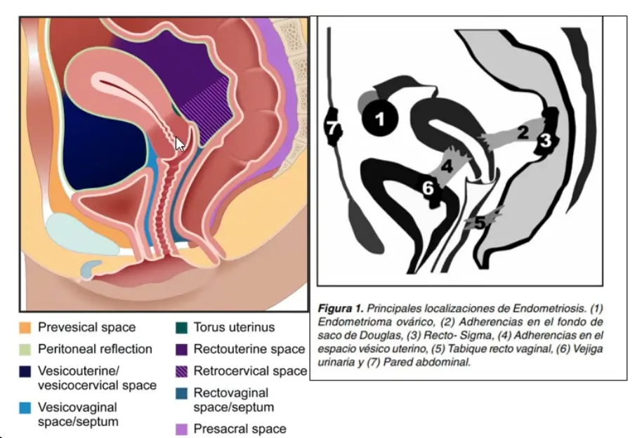 Endometriosis explicada para la pipol