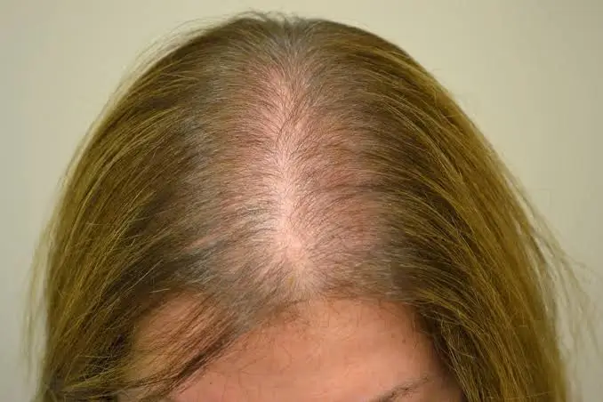 CAIDA DEL PELO FEMENINA
